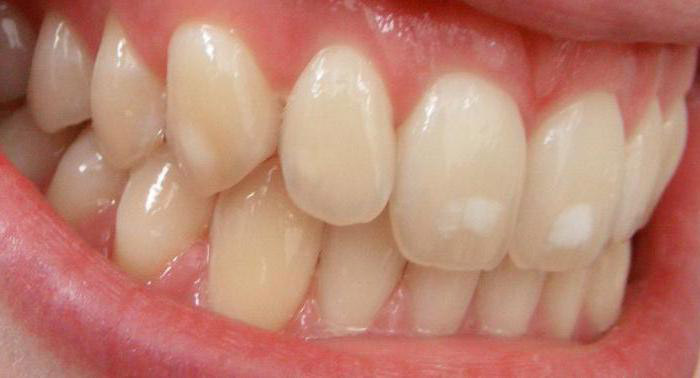 Флюороз зубов: почему возник и как вылечить?