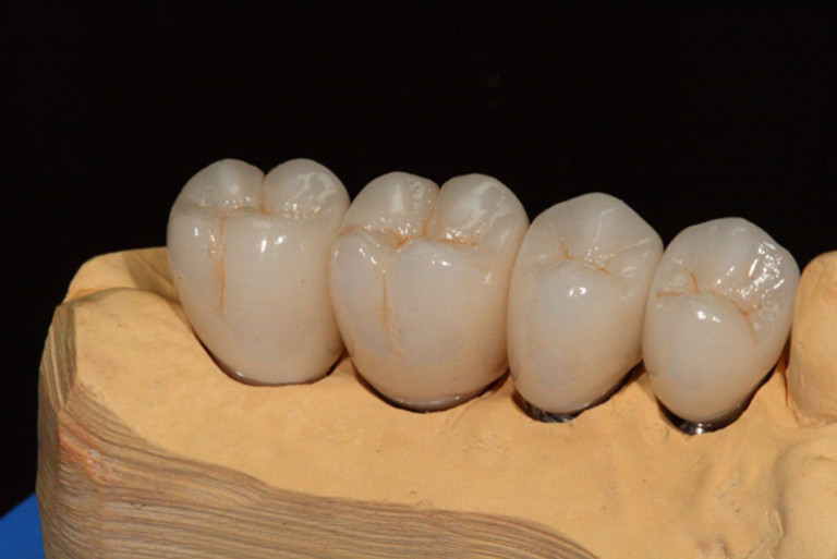 Коронки на основе диоксида циркония в стоматологической клинике «Здоровые зубы»