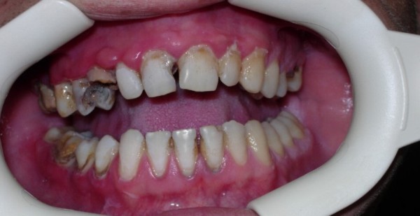 Гемисекция зуба: особенности и показания к процедуре