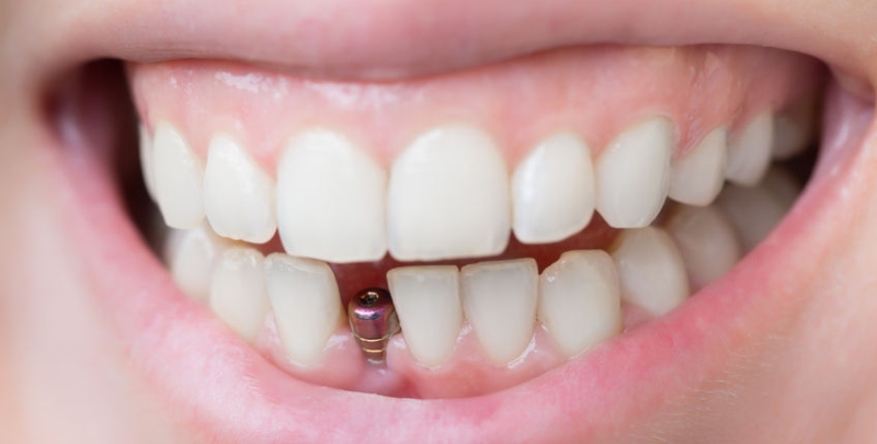 Что нужно знать о зубной коронке