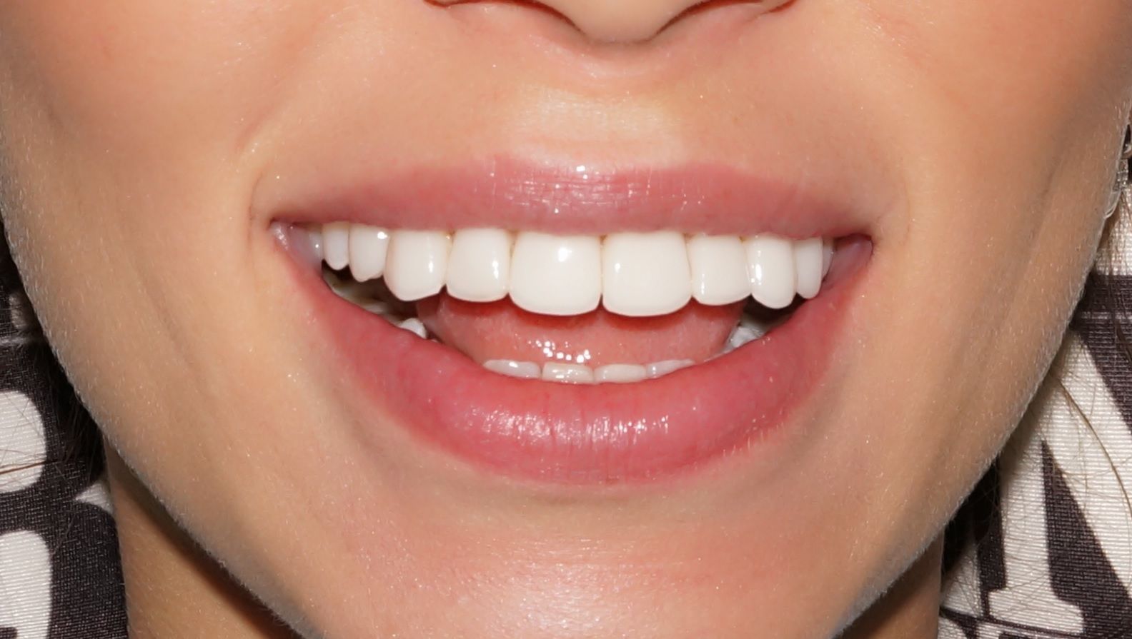 Люминеры на зубы