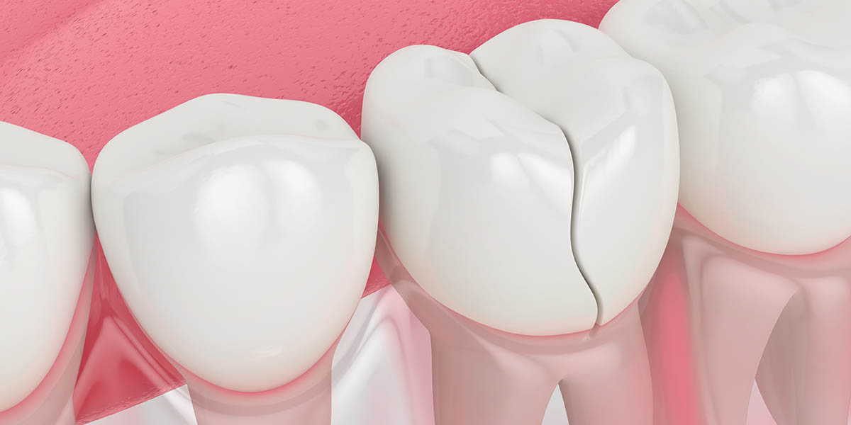 Трещина на зубе: причины, симптомы, лечение