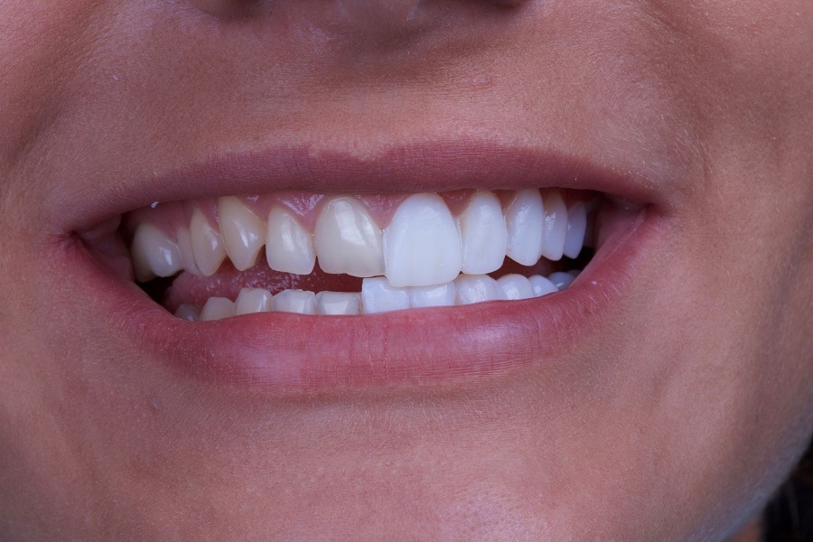 Установка виников в стоматологической клинике «Здоровые зубы»