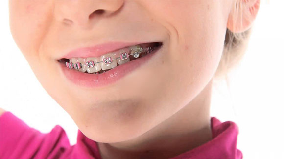 Выравнивание зубов с помощью брекетов у детей
