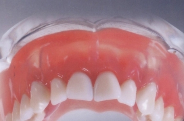 зубные протезы, протезирование зубов хабаровск