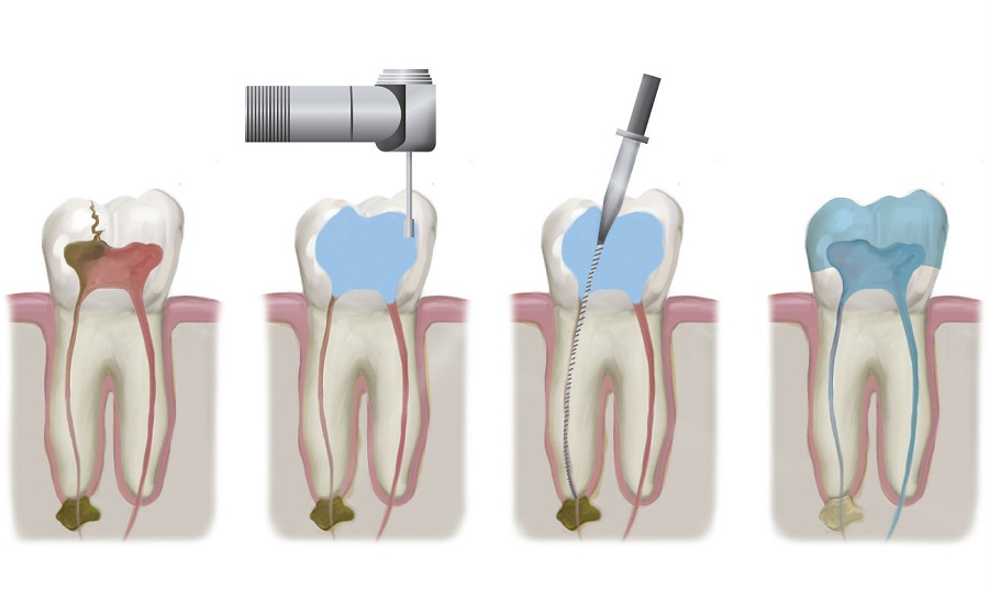 Эндодонтия в стоматологической клинике «Здоровые зубы»