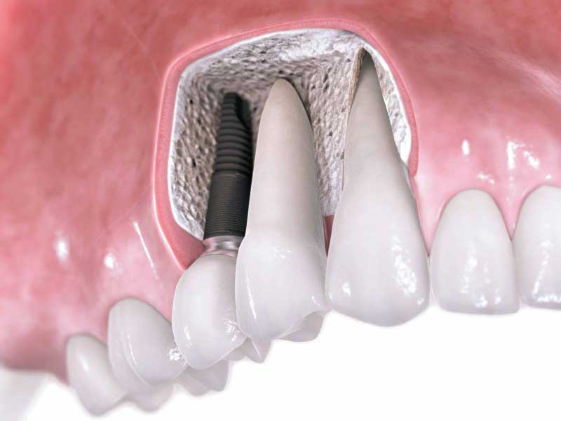 Зубные импланты какие лучше?