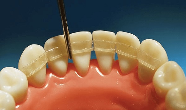 Шинирование зубов: виды и особенности процедуры