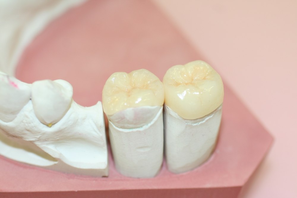 Керамические вкладки в стоматологической клинике «Здорове зубы»