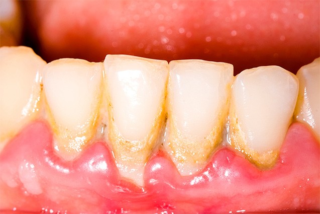 Зубной камень: чем опасен и как его победить